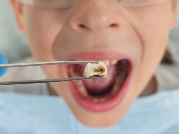 Best Emergency Treatment for Dental Infections or Abscesses in Massanetta Springs, VA